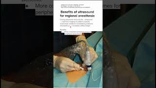 Benefits of ultrasound for regional anesthesia [upl. by Kwasi147]