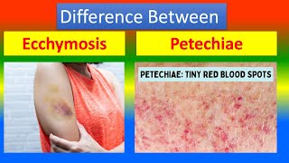 Distinction Between Ecchymosis and Petechiae [upl. by Assereht403]