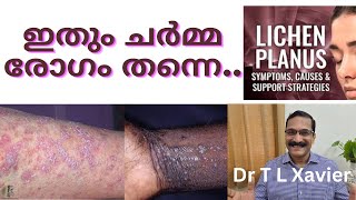 Lichen Planus Ayurvedic Solutions  Dr T L Xavier [upl. by Rabiah]