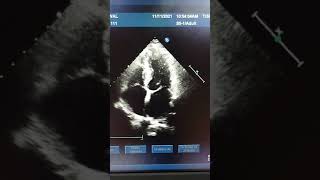 Mitral valve Myxomatous in 2d ECHO [upl. by Asiral]