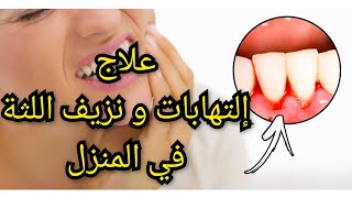 كيفية علاج إلتهابات و نزيف اللثة في المنزل دون طبيب و القضاء على رائحة الفم الكريهة [upl. by Tu]