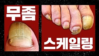 초록색 녹농균 발톱  Toenails with green Pseudomonas aeruginosa [upl. by Arras]