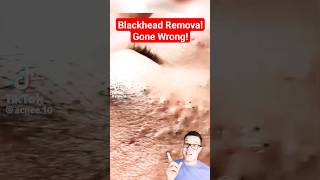 TERRIBLE BLACKHEAD REMOVAL  Shocked At This One shorts [upl. by Rehportsirhc]