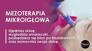 Mezoterapia mikroigłowa  najlepszy zabieg odmładzający [upl. by Kevan]