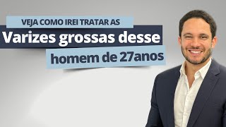 Veja como irei tratar varizes grossas desse homem de 27 anos [upl. by Parks]