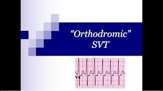 ECG Tip 20 What about quotOrthodromicquot SVT [upl. by Fougere]