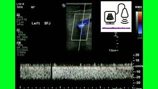 Monophasic Doppler Waveform [upl. by Selhorst206]