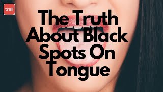 The Truth About Black Spots On Tongue blackspots youtube trell [upl. by Giordano]