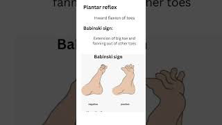 Babinski signUpper motor neuron lesionplantar reflex [upl. by Gans793]