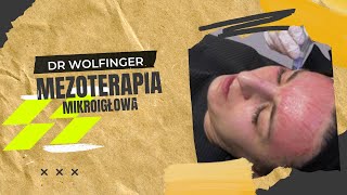 Dermapen  mezoterapia mikroigłowa [upl. by Janus]