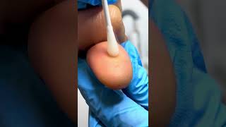 Freezing a Huge Wart with Liquid Nitrogen  Wart Removal Procedure 😬🧊 [upl. by Aserehtairam]