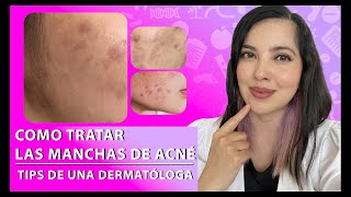 ¿Tienes MANCHAS POR ACNÉ Tips de una Dermatóloga 👩🏻‍⚕️👌🏻 [upl. by Pacifa]