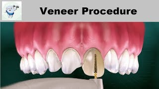 Dental Veneers Procedure Step by step [upl. by Ainolloppa]