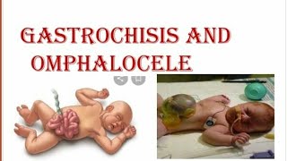 Gastroschisis and Omphalocele [upl. by Indyc]