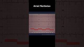 Atrial Fibrillation ECG Heart rate [upl. by Anneehs987]