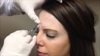 Allergan Botox Injections [upl. by Hearn]