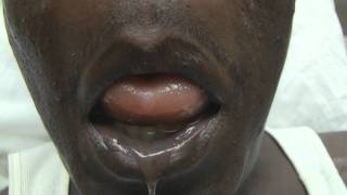 ACE Inhibitor Tongue Angioedema Emergency [upl. by Niad]