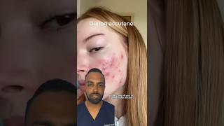 How does ACCUTANE work Dr Somji Explains [upl. by Najram152]