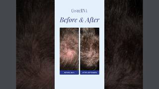 Revolutionary Antihair loss tonic beforeamp after cosmerna [upl. by Kristen953]