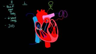 Left sided vs Right sided heart failure [upl. by Luella]