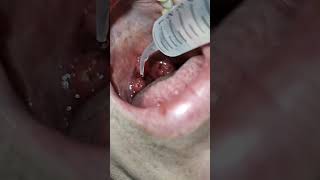 Tonsil Stones Explained In Under 3 Minutes [upl. by Farnham]