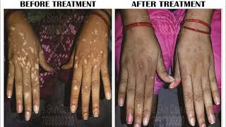 Lips Vitiligo Treatment in India  Berry Skin Care [upl. by Critchfield]