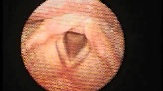 Larynx mild tremor of right vocal cord [upl. by Cayla275]