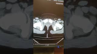 ctscan ct scan pelvic for more details in this video ct scan kaise karte hai shorts new video [upl. by Sallyann692]