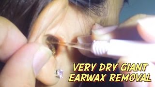 Very Dry Giant Earwax Removal [upl. by Ibib632]