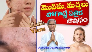 How To Remove Pimples Overnight  Acne Treatment  Dr Manthena Satyanarayana Raju  GOOD HEALTH [upl. by Leonhard768]