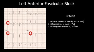 How to Read an ECG Fascicular blocks LAFB LPFB RBBB and LAFB RBBB and LPFB [upl. by Selle862]