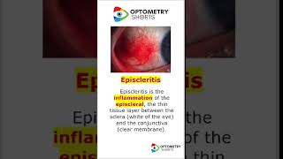 👁️‍🗨️ Episcleritis or conjunctivitis Thats the question EyeHealthepiscleritis eyesoptometry [upl. by Heilner961]