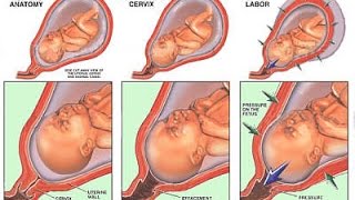 Incompetent Cervix  Losing a pregnancy before 24 weeks [upl. by Eselahc]