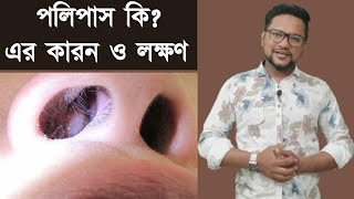 নাকের পলিপাস কি পলিপাসের কারন ও লক্ষণ। নাকের পলিপাস এর লক্ষণ। পলিপাস হলে কি কি সমস্যা হয়। পলিপাস [upl. by Aretta]