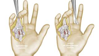 Maladie de Dupuytren  guérison et traitement naturel ou chirurgical [upl. by Ajiak]