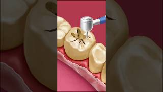 Dental Care ASMR  Gentle Tooth Cleaning Animation  tartar remove amp dental filling treatment [upl. by Cerveny]