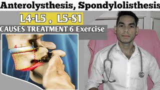 Anterolisthesis spondylolisthesis L5s1 spondylolisthesis Treatment Exercise Low back pain [upl. by Fanya]