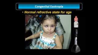 Congenital Esotropia [upl. by Mellicent]