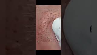 Blackheads Removal  Acne Treatment and Very Satisfying Satisfying Pimple pop blackheads [upl. by Thorndike]