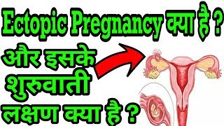 Ectopic Pregnancy Kya Hai Hindi  Ectopic Pregnancy Starting Symtoms  Ectopic Pregnant Ke Lakshan [upl. by Lazaro321]