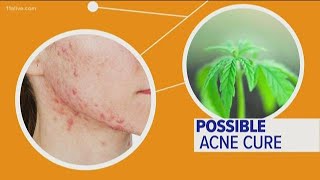 Can CBD oil really help with acne [upl. by Behn]