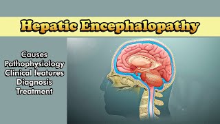 Hepatic Encephalopathy Pathophysiology Clinical Features Diagnosis amp Treatment [upl. by Ivzt]