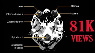 How to read ct scan of Brain [upl. by Primalia]