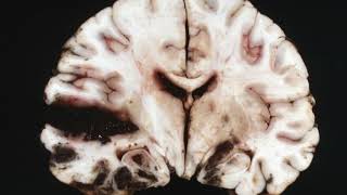 Difference Between Glioma and Glioblastoma [upl. by Doyle]