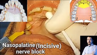 Local Anesthesia Nasopalatine Nerve block technique Maxillary anesthesia Techniques dentistry [upl. by Cerf]