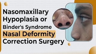 Nasal Correction in Nasomaxillary Hypoplasia  Nose correction Surgery in Delhi  Dr PK Talwar [upl. by Ulita]