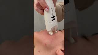 LPG Facial london skincare [upl. by Odlo]