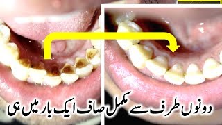 Teeth Whitening amp Try it Once And See The Result  2018 [upl. by Eimaral]