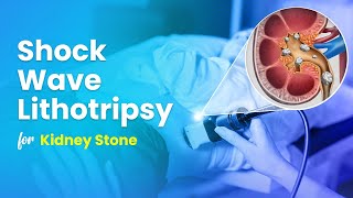 Shock Wave Lithotripsy ESWL for Kidney Stone Treatment  3D Guide [upl. by Marino]