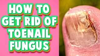 Toenail Fungus Treatment at Home A Fast Cure You Must Try [upl. by Gonick]